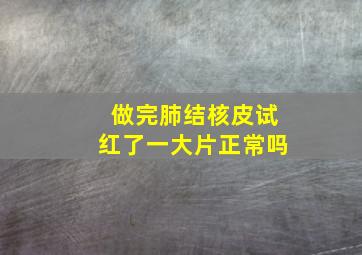 做完肺结核皮试红了一大片正常吗