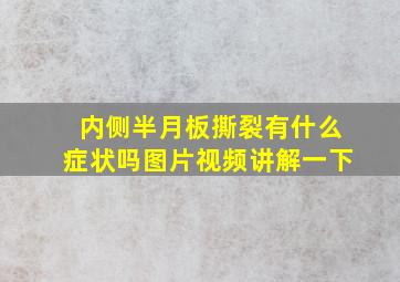 内侧半月板撕裂有什么症状吗图片视频讲解一下