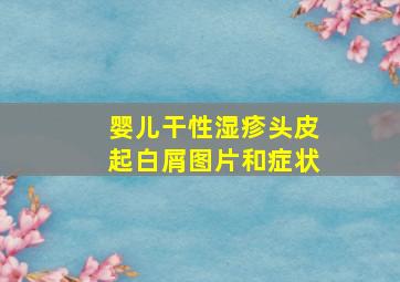 婴儿干性湿疹头皮起白屑图片和症状