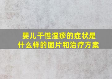 婴儿干性湿疹的症状是什么样的图片和治疗方案