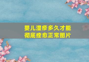 婴儿湿疹多久才能彻底痊愈正常图片