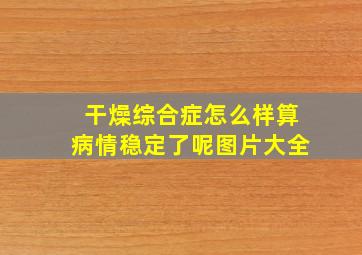 干燥综合症怎么样算病情稳定了呢图片大全