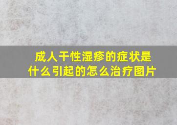 成人干性湿疹的症状是什么引起的怎么治疗图片