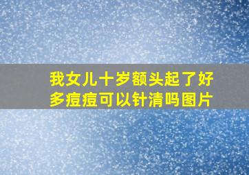 我女儿十岁额头起了好多痘痘可以针清吗图片