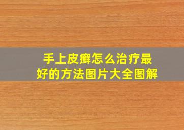 手上皮癣怎么治疗最好的方法图片大全图解