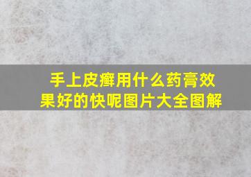 手上皮癣用什么药膏效果好的快呢图片大全图解