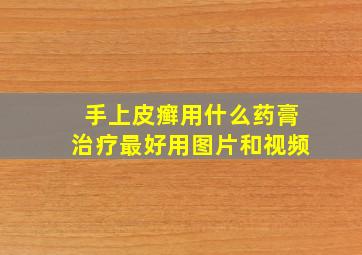 手上皮癣用什么药膏治疗最好用图片和视频