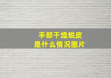 手部干燥蜕皮是什么情况图片