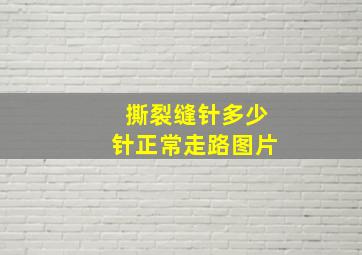 撕裂缝针多少针正常走路图片