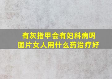 有灰指甲会有妇科病吗图片女人用什么药治疗好