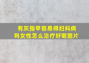 有灰指甲容易得妇科病吗女性怎么治疗好呢图片