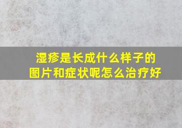 湿疹是长成什么样子的图片和症状呢怎么治疗好