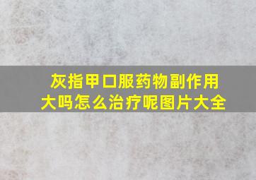 灰指甲口服药物副作用大吗怎么治疗呢图片大全