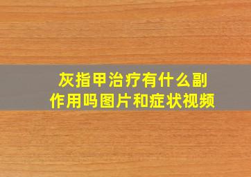 灰指甲治疗有什么副作用吗图片和症状视频