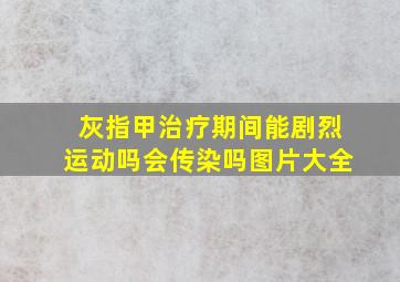 灰指甲治疗期间能剧烈运动吗会传染吗图片大全