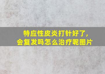 特应性皮炎打针好了,会复发吗怎么治疗呢图片