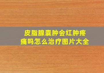 皮脂腺囊肿会红肿疼痛吗怎么治疗图片大全