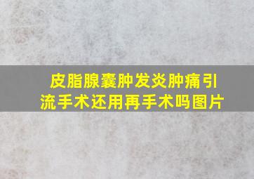 皮脂腺囊肿发炎肿痛引流手术还用再手术吗图片