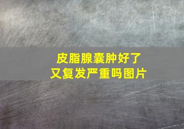 皮脂腺囊肿好了又复发严重吗图片