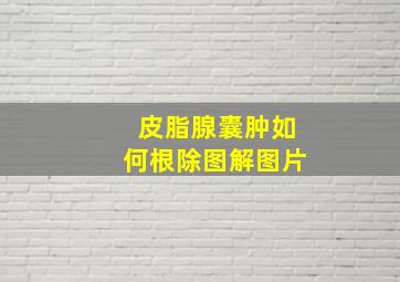 皮脂腺囊肿如何根除图解图片