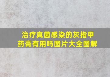 治疗真菌感染的灰指甲药膏有用吗图片大全图解