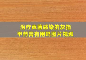 治疗真菌感染的灰指甲药膏有用吗图片视频